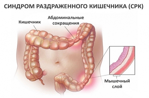 Обложенный язык при синдроме раздраженного кишечника