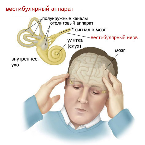 Синдром вегетативной дисфункции с вестибулопатией