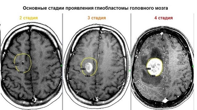 Основные стадии проявления глиобластомы Основные стадии проявления глиобластомы