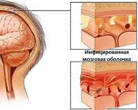 Менингеальный синдром Менингеальный синдром