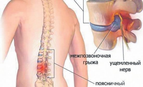 Поясничный остеохондроз