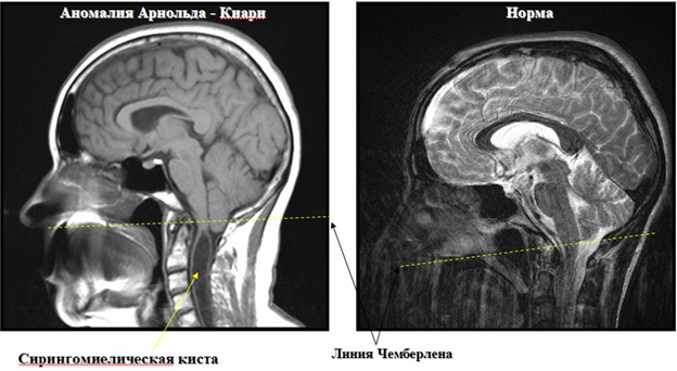 Результаты МРТ при аномалии Арнольда Киари с сирингомиелической кистой и в норме У плода синдром арнольда киари