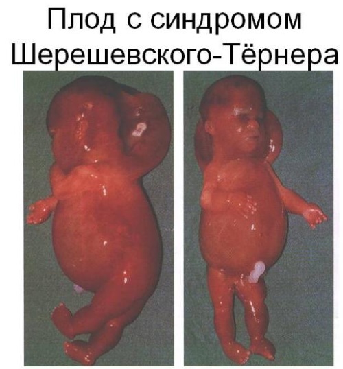 Синдром Шерешевского-Тернера. Кариотип, что это такое, причины, лечение, диагностика