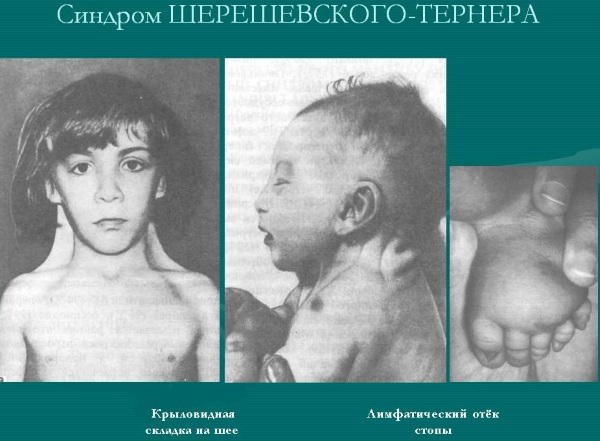 Синдром Шерешевского-Тернера. Кариотип, что это такое, причины, лечение, диагностика
