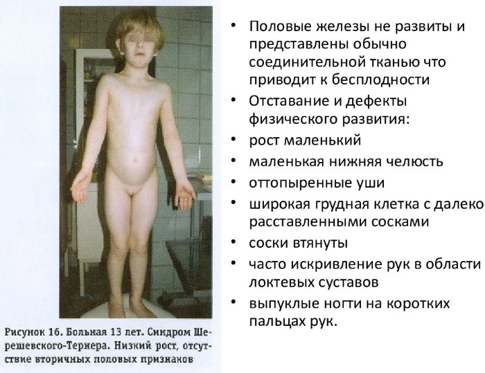 Синдром Шерешевского-Тернера. Кариотип, что это такое, причины, лечение, диагностика