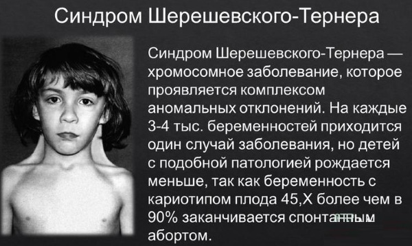 Синдром Шерешевского-Тернера. Кариотип, что это такое, причины, лечение, диагностика