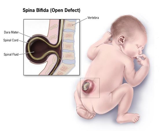 Спинно-мозговая грыжа при spina bifida