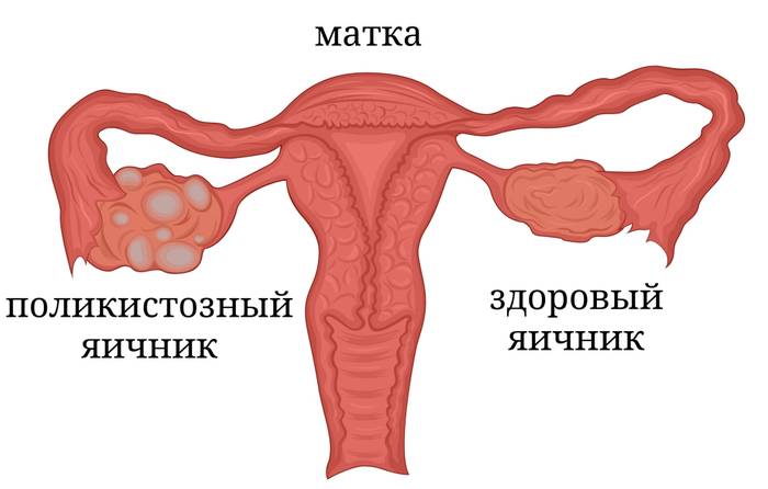 кисты в яичнике при синдроме поликистозных яичников наличие большого количества кист при СКПЯ