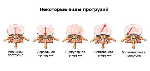 Протрузия межпозвонкового диска проходит 3 этапа и классифицируется по направлению выпячивания